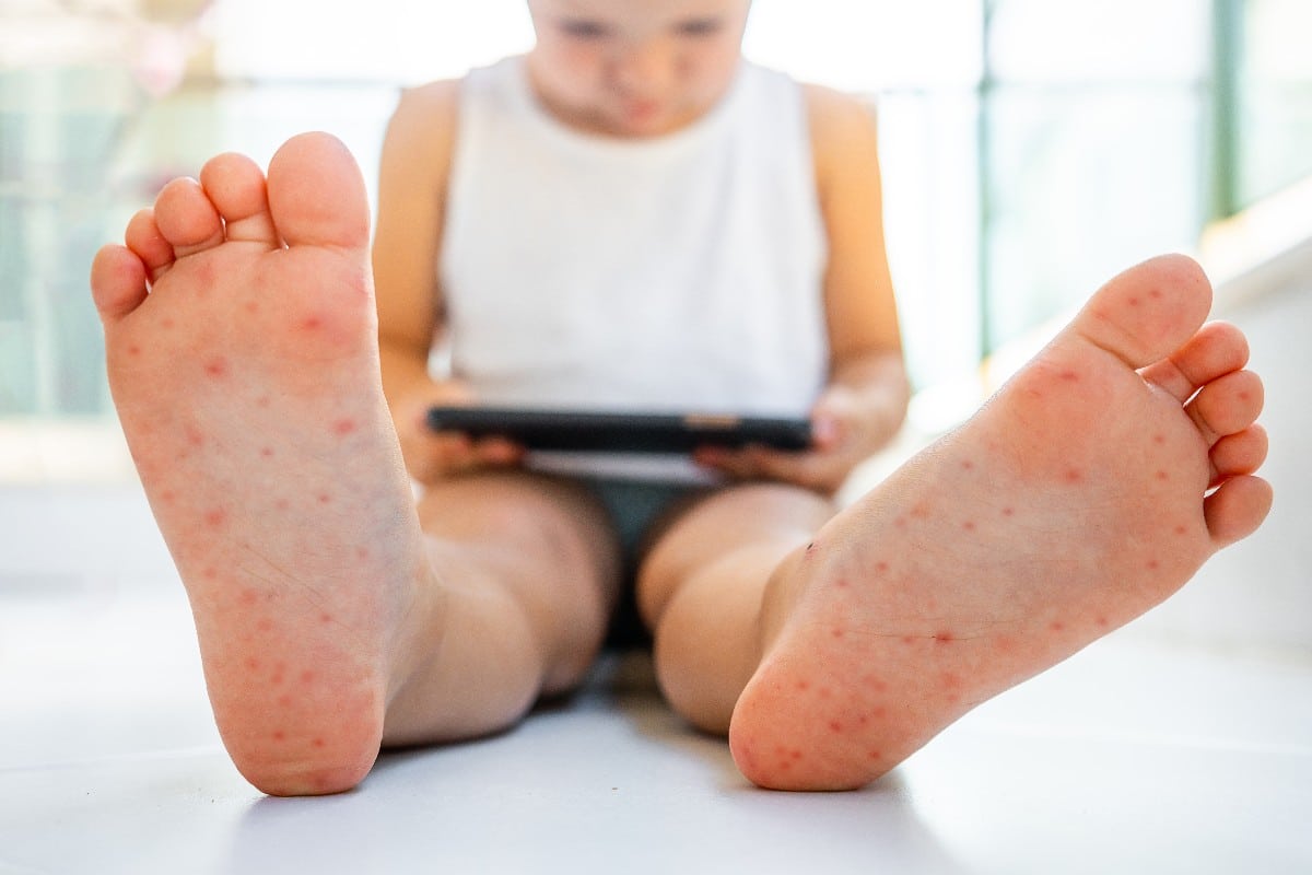 Un enfant atteint du syndrome pieds-mains-bouche